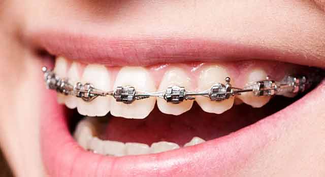 conventional-braces