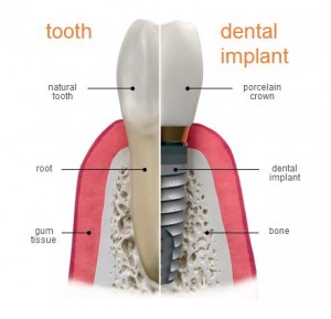 about-dental-implants