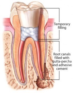 root canal treatment procedure - canal filling