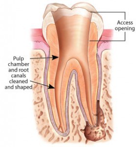 root canal treatment - pulp chamber