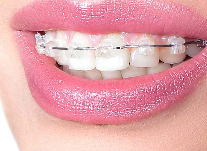 Clear Braces