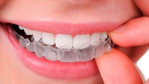 Braces - Invisalign