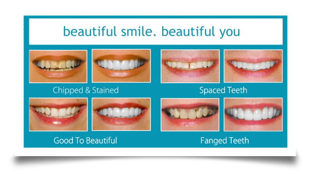dental veneers before and after images
