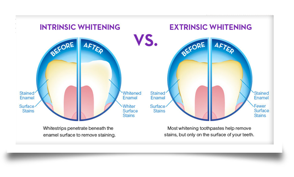 teeth whitening intinsic and extrinsic teeth whitening